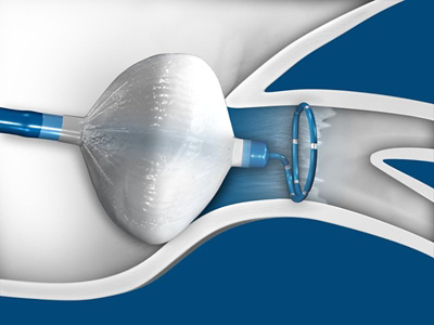 atrial fibrillation4