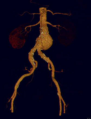 bacuhaortenaneurysma