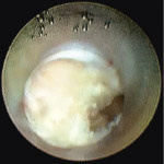 bandscheibe_endoskopsicht_1