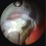 bandscheibe_endoskopsicht_2