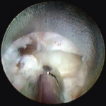 bandscheibe_endoskopsicht_3