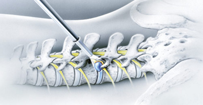 bandscheibenvorfall_minimalinvasiv_gross