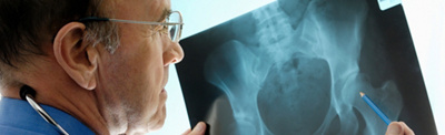 The Silent Bone Disease: Spotting Osteoporosis Early 