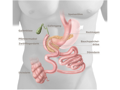 Biliopankreatische Diversion mit duodenal switch