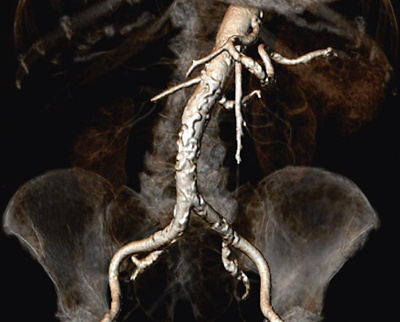 bauchhauptschlagader_3D