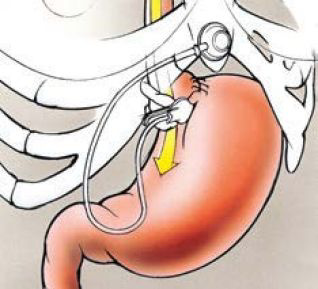 Berner Viszeral Chirurgie Anpassbares Magenband