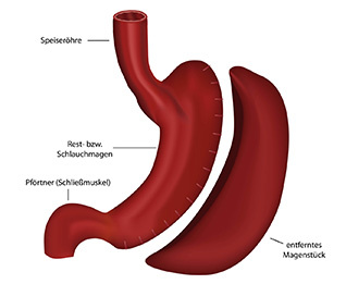 Berner Viszeral Chirurgie Schlauchmagen