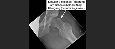 blogbeitrag-huefte-impingement-roentgenbild-praeop