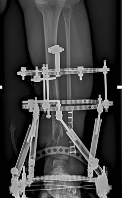 bone reconstruction3