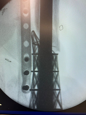 bone reconstruction5