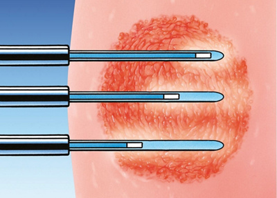 Animation Brachytherapie