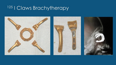 New claws brachytherapy to treat eye tumours