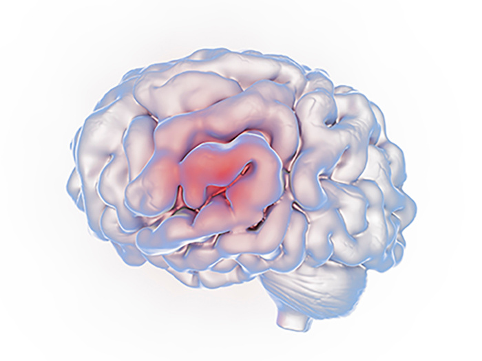 Brain tumours and Intracranial growths Mediclinic City Hospital