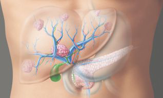 chirurgisches-zentrum-irreversible-elektroporation-schema-lebermetastasen