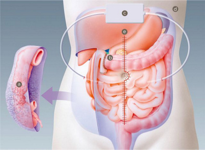 chirurgisches-zentrum-schema-postoperative-spuelung