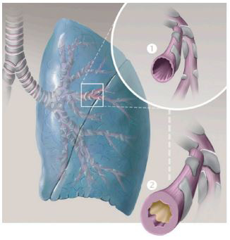 Chronische Bronchitis