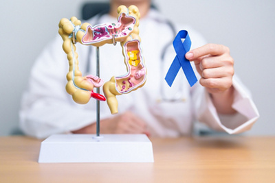 colorectal cancer