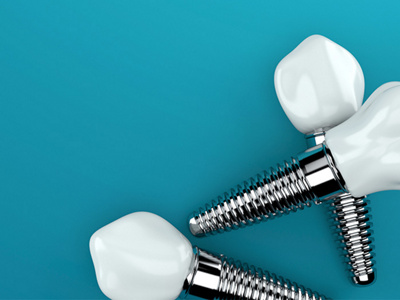 dental-implants