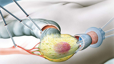 enddarmkrebs_minimalinvasiv