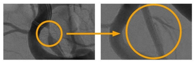 Links: Hochgradige Verengung der linken Penis versorgenden Arterie direkt am Abgang aus der inneren Beckenschlagader bei einem 51-jährigen Raucher mit erektiler Dysfunktion.Rechts: Gefässdarstellung (Angiographie) nach Ballonkatheter-Behandlung (mit Stent)
