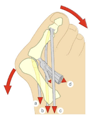 hallux-operation-eine-100-prozentige-sache-1