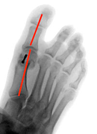 hallux-operation-eine-100-prozentige-sache-2