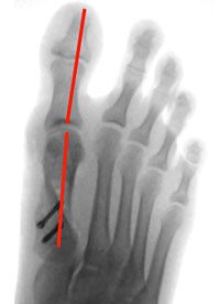 hallux-operation-eine-100-prozentige-sache-3