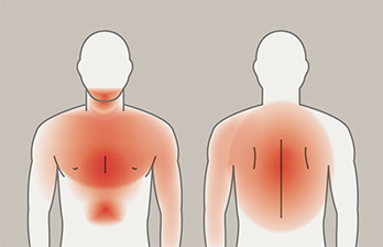herzinfarkt_schaubild