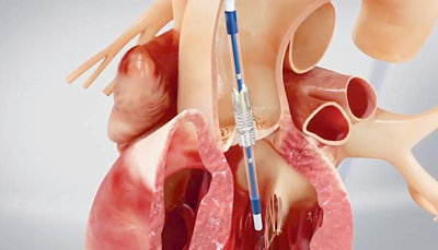 herzklappenprothese_platzierung