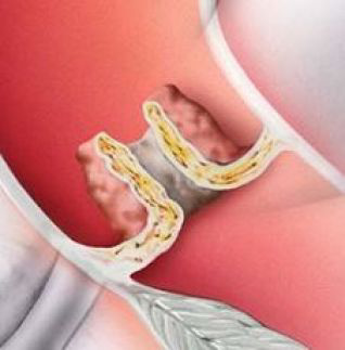 Aortenklappenstenose