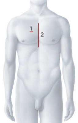 Chirurgischer Klappenersatz Körper