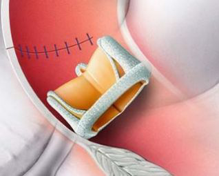 Chirurgischer Klappenersatz