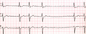 EKG Vorhofflimmern