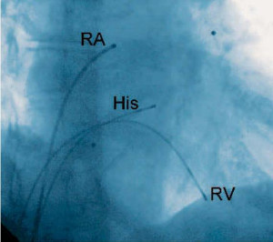 Elektrophysiologische Untersuchung Vorhofflimmern