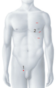 Operationszugänge Herzohrverschluss