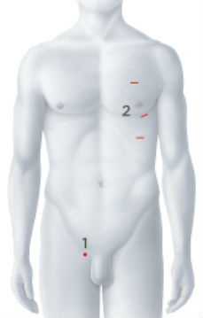 Operationszugänge Herzschrittmacher