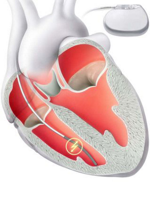 Interner Defibrillator