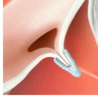 Katheterbasierte Mitralklappenrekonstruktion