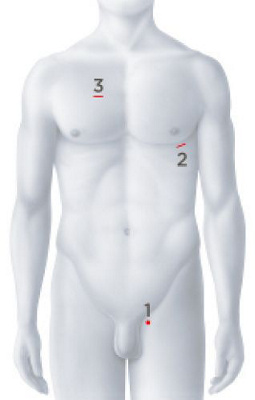 Katheterbasierter Klappenersatz Körper