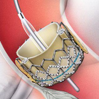 Katheterbasierter Klappenersatz