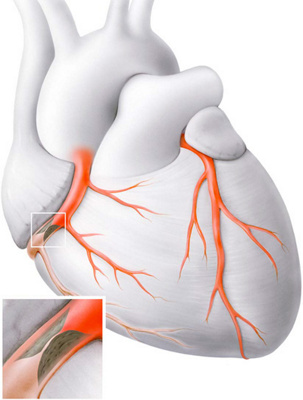 Visualisation d'une maladie coronarienne