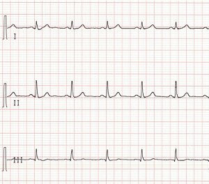 Normales EKG = Regelmässig