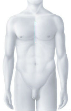 Operationszugang Bypass