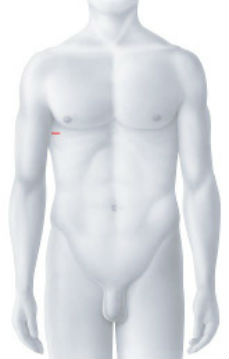 Operationszugang Chirurgische Mitralklappenrekonstruktion