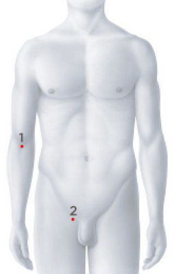 Operationszugänge Stentimplantation