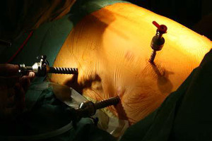 Zugänge Vorhofflimmern