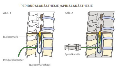 Periduralanästhesie/Spinalanästhesie
