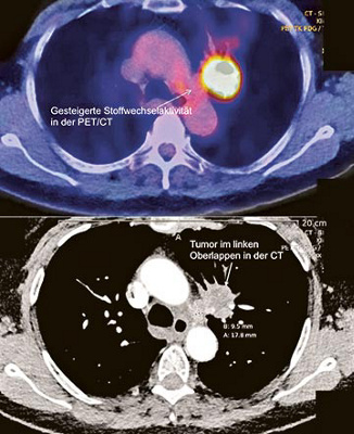 hirsladen-die-interdisziplinaere-behandlung-des-lungenkrebses-2
