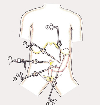 hirslanden-20-jahre-laparoskopische-dickdarmchirurgie-2