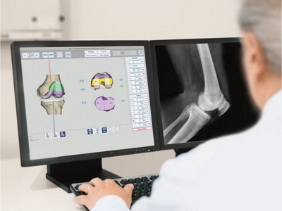 hirslanden-3d-schablone-zur-genauen-positionierung-der-knieprothese-1
